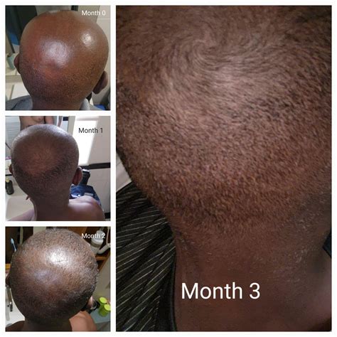 3 Months Progress Topical Fin Minoxidil R Tressless