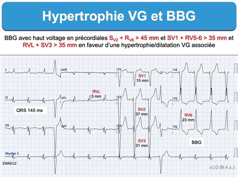 Hypertrophie Vg Hvg 2 Bbg E Cardiogram