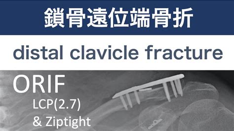 Distal Clavicle Fracture 鎖骨遠位端骨折 Orif【上肢2】 Youtube