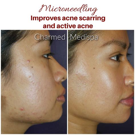 Acne Scar Reduction Charmed Medispa