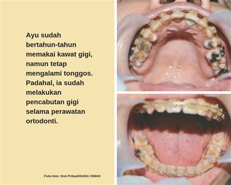 Jeo Pasang Kawat Gigi Jangan Cuma Asal Mau Bikin Rapi