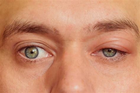 Swollen Eyelids Causes And Treatments The Eye News