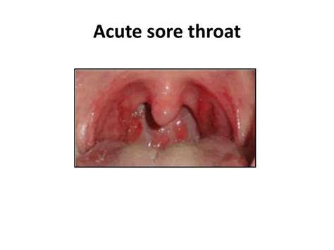 Ppt Acute Sore Throat Infection And Treatment Dr Sheetu Singh