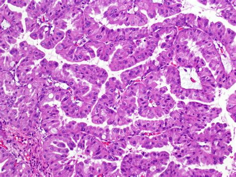 Pathology Outlines Intraductal Oncocytic Papillary Neoplasm