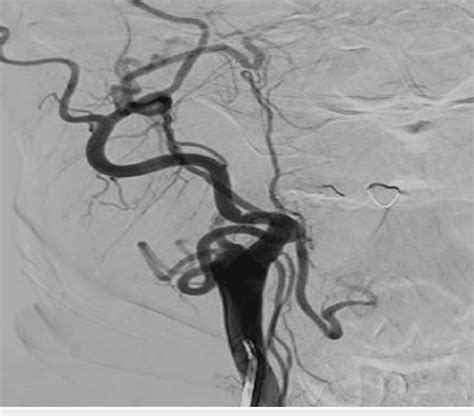 Anterior Posterior Cerebral Angiogram Demonstrating Spontaneous