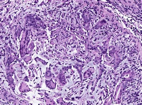 Xanthogranulomatous Mastitis