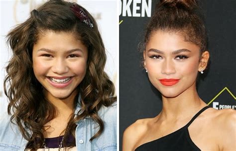 Zendaya Before and After Plastic Surgery