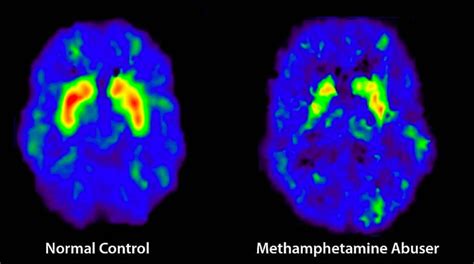 The Devastating Effects of Meth on the Brain and Mental Health