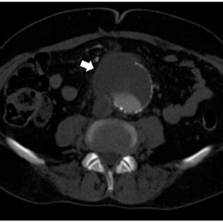 Preoperative CT Scan Showing An Abdominal Aortic Aneurysm Surrounded