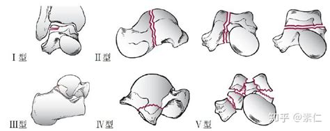 距骨骨折 知乎