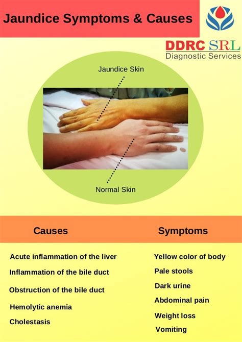 Jaundice Symptoms & Causes