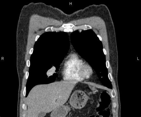 Pulmonary Arteriovenous Malformations Bilateral Image Radiopaedia Org