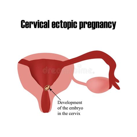 Desarrollo Del Embrión En La Cerviz Embarazo Ectópico Ilustración Del