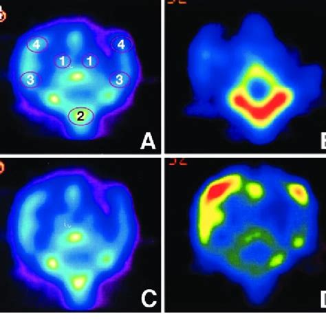 A Regions Of Interest Rois Were Placed On The Coronal Image