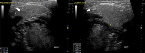 Figure From Asymptomatic Unilateral Aplasia Of The Left Parotid Gland