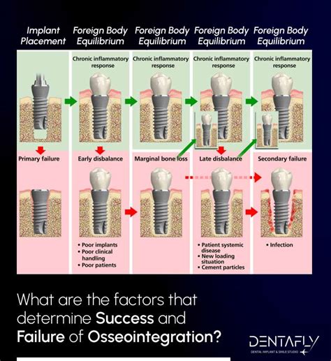 Osseointegration A To Z Overview Denta Fly