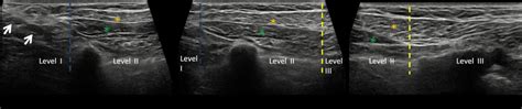 Ultrasound Axial Images Show The Axillary Lymph Node Levels I Ii And