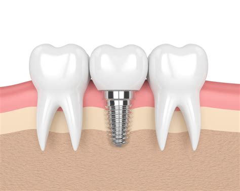 Dental Bridges Vs Implants Which Is The Best Option For You