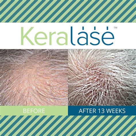 KeraLase Before And After Hair Nutrients Scalp Health Healthy Hair Care