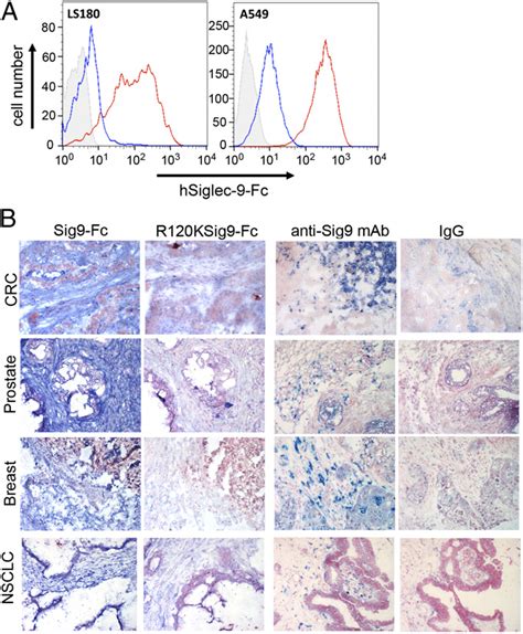 Ligands For Siglec Are Up Regulated In Human Carcinomas A Ls