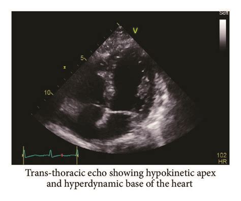 4 Chamber View Transthoracic Echocardiogram Download Scientific Diagram