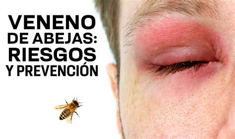 Qué hacer cuando te pica una abeja UNAM Global