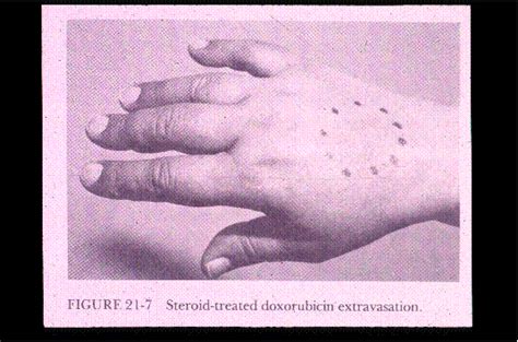 Doxorubicin Extravasation