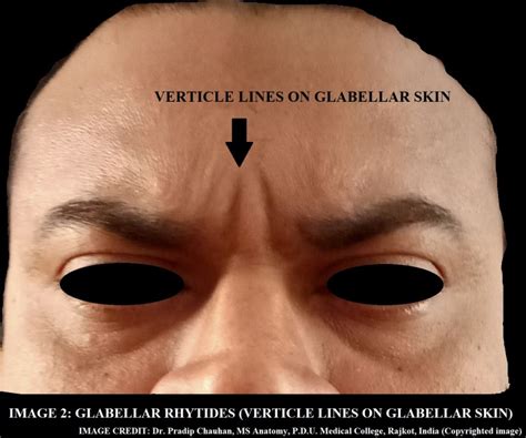 Anatomy Head And Neck Glabella Statpearls Ncbi Bookshelf