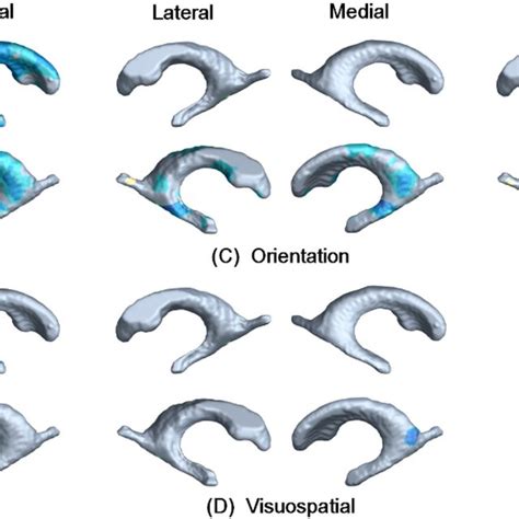 Correlations Between Ventricular Surface Morphological Feature And