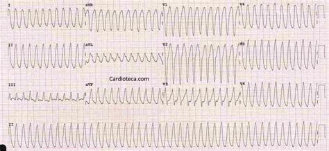 Taquicardia Ventricular Ekg