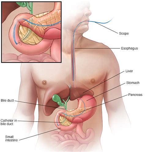 Primary Sclerosing Cholangitis Causes Symptoms Prognosis Treatment