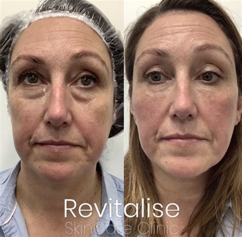 Hollow Under Eye Treatment Tear Trough Revitalise Skincare Clinic