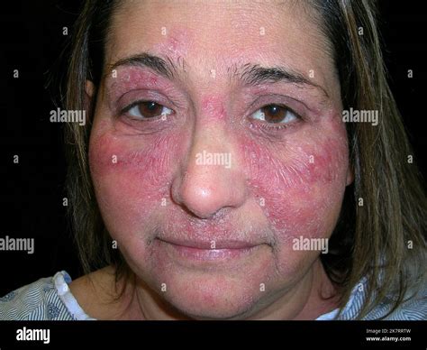 Dermatitis At Pica En La Cara De Una Paciente De S A Os La