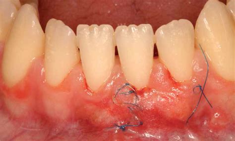 Lectura de Periodoncia Cirugía plástica periodontal Fundación Creo