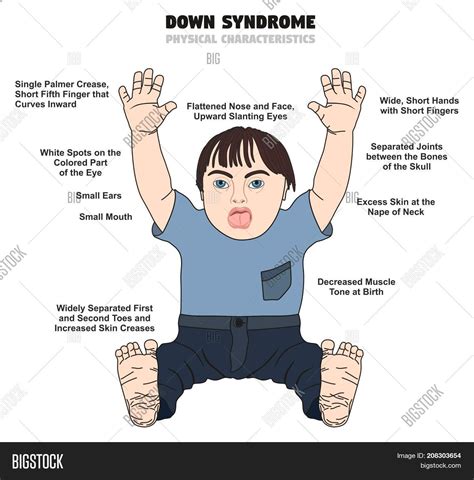 Down Syndrome Physical Image Photo Free Trial Bigstock