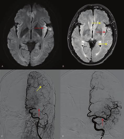 Illustrative Case Of Fvh Dwi Mismatch Hyperintense Lesions In The Left