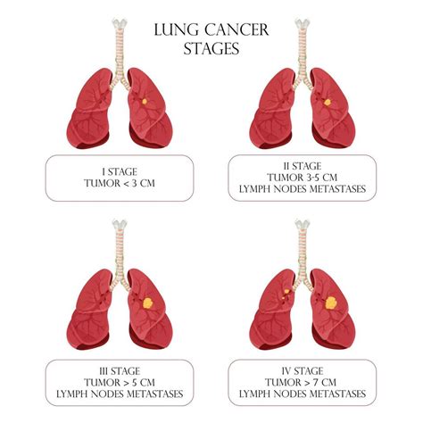 Lung cancer stages. Concept diseases human internal organs. Cartoon style, vector illustration ...