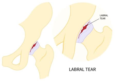 Hip Labrum Repair And Reconstruction Rockwall TX Manoj Reddy