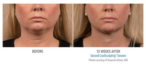 Coolsculpting Double Chin Neck Jawline Results 389 Female Submentum New Radiance Cosmetic