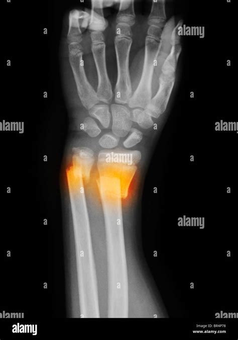 Distal Ulna Dislocation