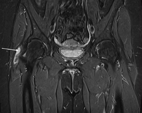 Trochanteric Bursitis and Gluteal Tendinopathy – Assessment and ...