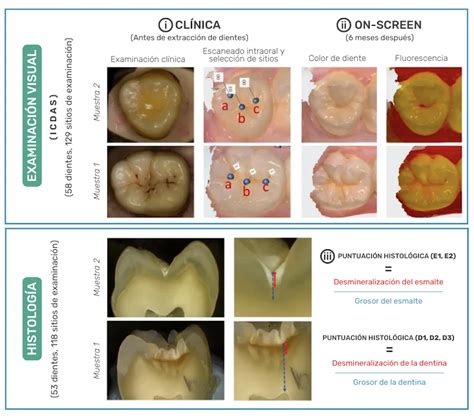 Un Estudio Concluy Que El Esc Ner Intraoral Trios Detecta Las Caries