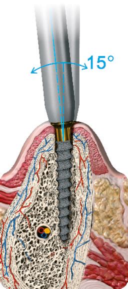 Implantes Basales Oliver Y Alcazar