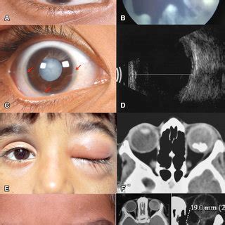 Clinical Presentation And Outcome Of Retinoblastoma Based On Age At