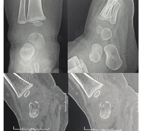 Ankle Imaging X Ray Of The Ankle Showing A Lytic Lesion Of The Talus Download Scientific