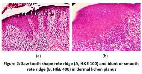 Lichen Planus Histological Features