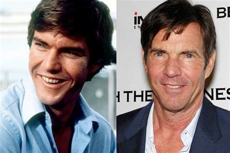 Dennis Quaid Plastic Surgery Botox Eyelid Surgery Before And After