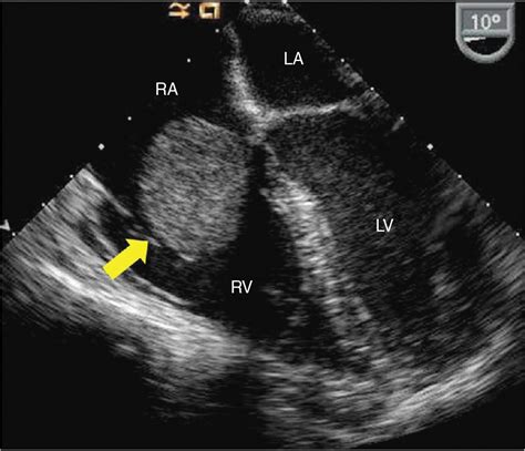 Echocardiography In The Evaluation Of Intracardiac Masses Thoracic Key