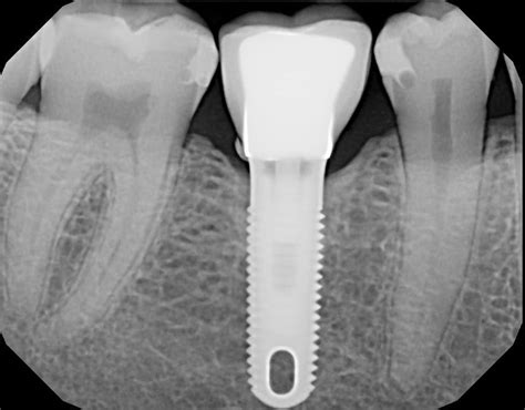 Crown Cement Below Gums Advanced Dentistry And Dental Implant Center