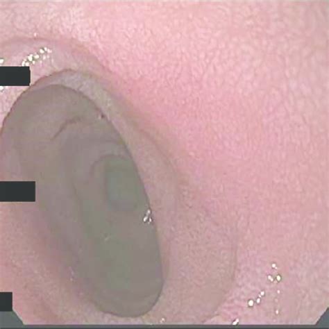 Endoscopic Photo Of The Patient S Duodenum The Duodenal Mucosa Appears Download Scientific